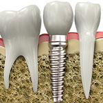 Dental Implants, Burlington Ontario Dentist